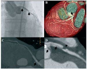 Coronary Artery Dissection Follow Up by MDCT Revista Española de