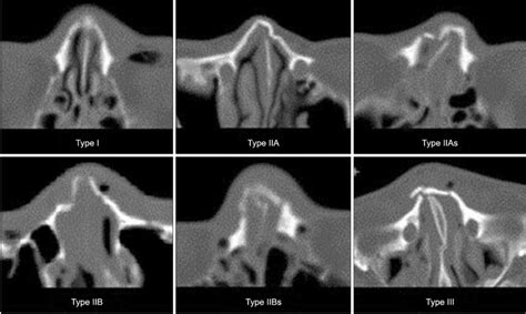 Nasal Fracture