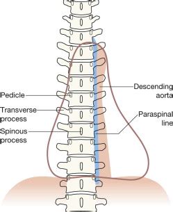 Thoracic Lumbar Spine Clinical Tree