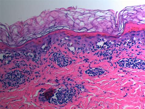 Atypical Presentation Of Erythema Multiforme Bmj Case Reports