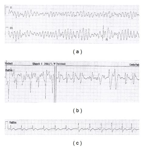 Aed Rhythm Strip Demonstrating A Tdp In Leads Ii And Iii B Download Scientific Diagram