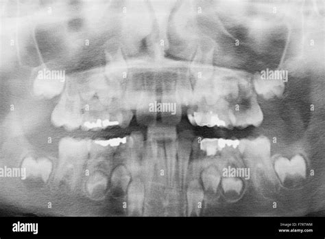 Kids Panoramic Human Teeth Dental X Ray Stock Photo Alamy