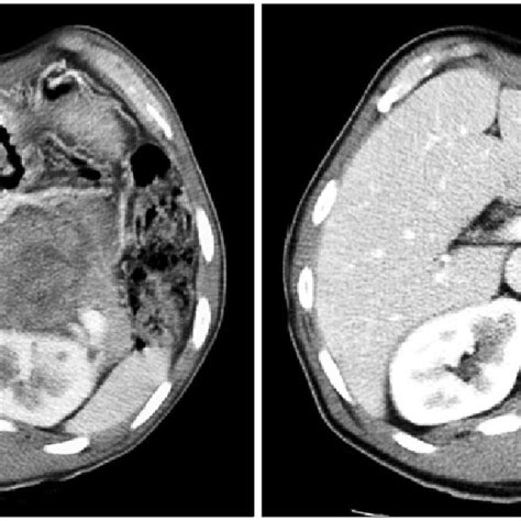 Pre And Post Treatment Ct Scans In Case 2 Ct Scans At Diagnosis Left Download Scientific