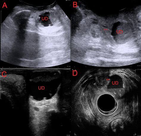 Urethral Diverticulum Ultrasound