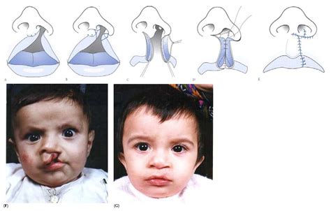 Cleft Lip And Palate Surgery Intechopen