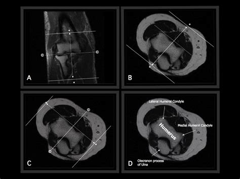 MRI BLOG: Elbow MRI