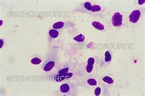 Pneumocystis Jirovecii Trophs Lm Stock Image Science Source Images