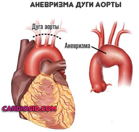 Аневризма аорты сердца что это такое, симптомы, лечение и прогноз