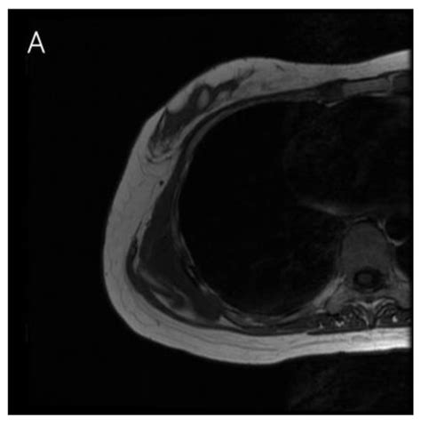 Scapulothoracic Bursitis Mri