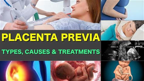 Placenta Previa Types And Symptoms Placenta Previa Causes Pregnancy Treatment Placenta Delivery