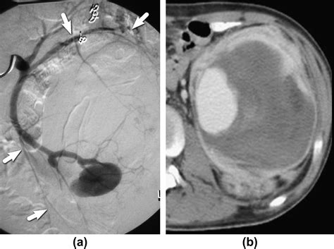 Embolization Of Renal Angiomyolipoma Immediate Complications And Long