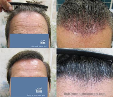 Dr Timothy Carman Hair Transplantation Procedure Before And After