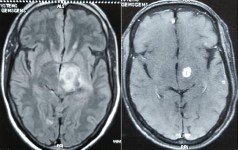 Hemichorea-hemiballismus following treatment of Intracranial ...