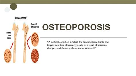 Osteoporosis Pathophysiology Diagnosis And Treatment 🏥 Youtube