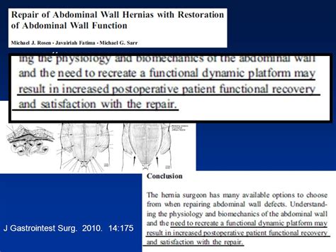 Restoring Abdominal Wall Function The Holy Grail Brian Jacob Md Facs