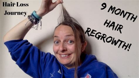 My Telogen Effluvium Recovery Story 9 Month Update And Hair Regrowth Youtube