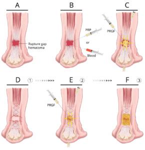 Cirurgia Sutura De Tend O De Aquiles Centro De Preserva O Articular