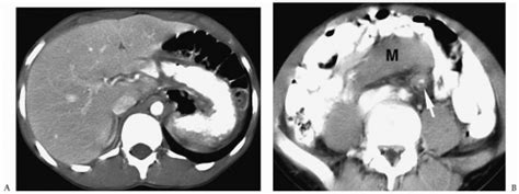 Spleen And Peritoneal Cavity Radiology Key