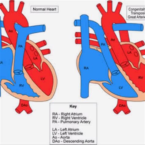 Congenitally Corrected Transposition Of The Great Arteries Cctga