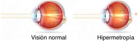 Hipermetropía ¿qué Es Y Cómo Se Trata Área Oftalmológica Avanzada