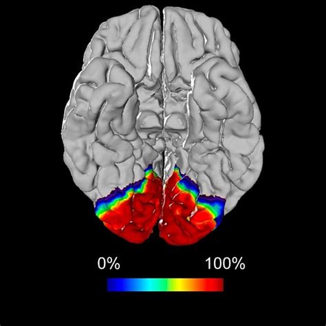 Primary Visual and Visual Association Cortex (Areas 17, 18, 19) | Radiology Key