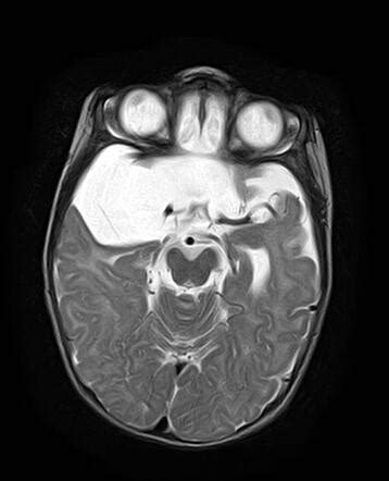 Arachnoid Cyst Middle Cranial Fossa Radiology Case Radiopaedia Org