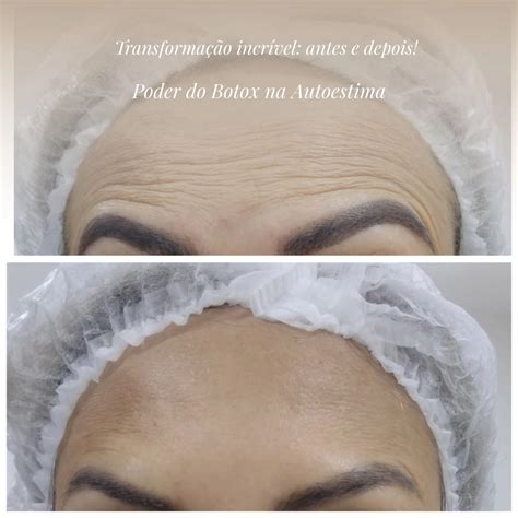 Estetica Pode Fazer Botox - Estética - Descubra o poder transformador do botox na autoestima! 💫 🌟 ...