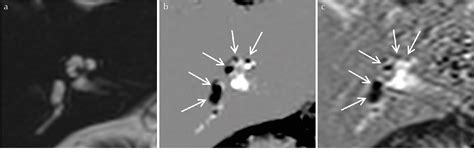 Figure 2 From Quantification Of Endolymphatic Space Volume After