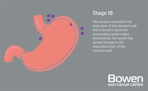 What Is Stomach Cancer Stomach Cancer Explained