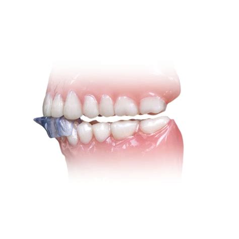 Férula dental para el bruxismo NTI tss Plus Glidewell Europe