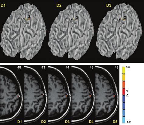 Activation In Area 1 I And Area 2 TopGyral Maps From 1 Subject