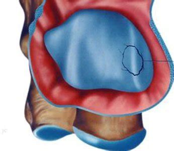 Lesioni Osteo Cartilaginee Massimo Drommi