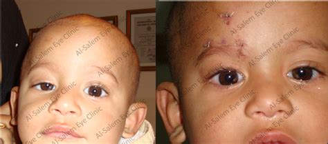 Ptosis Droopy Lid Al Salem Eye Clinic