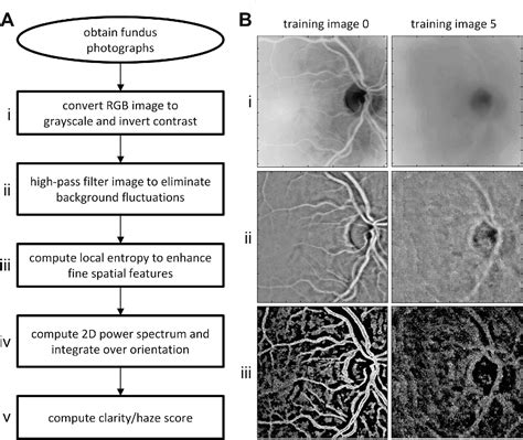 Pdf Automated Method Of Grading Vitreous Haze In Patients With