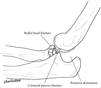 Anatomy Definition And Treatment Of The Terrible Triad Of The Elbow