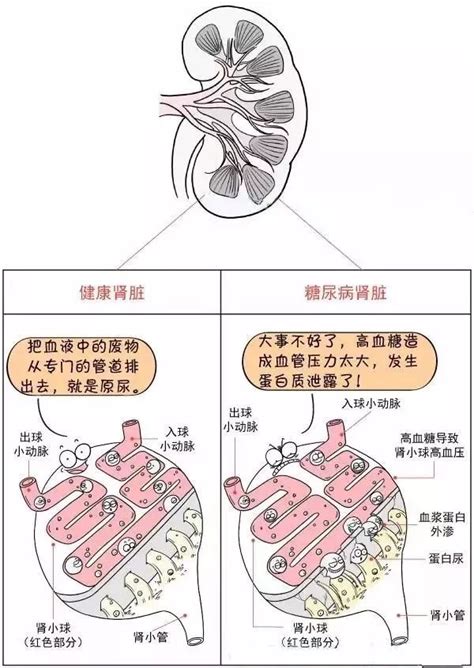 漫画解读 糖尿病并发症伤及全身凤凰网