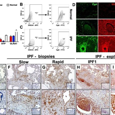 Dna Pkcs Expression Is Reduced In Ipf Lung Tissues A D Shown Are