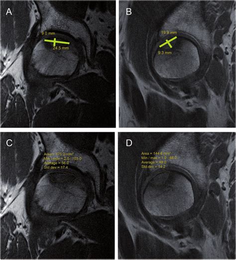 Maximal Measures And Area Yellow Lines Of The Avascular Necrosis Of