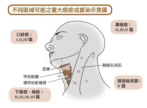 脖子上有腫塊，要看耳鼻喉科！醫師教你用外觀初步判斷：腫塊是良性還是惡性 良醫健康網