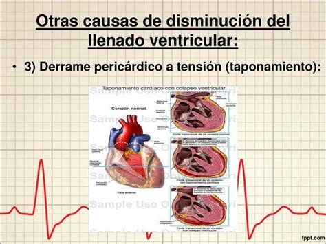 PPT INSUFICIENCIA CARDÍACA PowerPoint Presentation free download