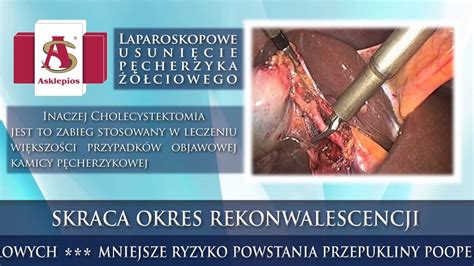 CHOLECYSTEKTOMIA LAPAROSKOPOWE USUNIĘCIE PĘCHERZYKA ŹÓŁCIOWEGO YouTube