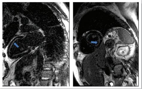 Diagnosis Of Cardiac Amyloidosis Amyloidosis Patient Information Siteamyloidosis Patient