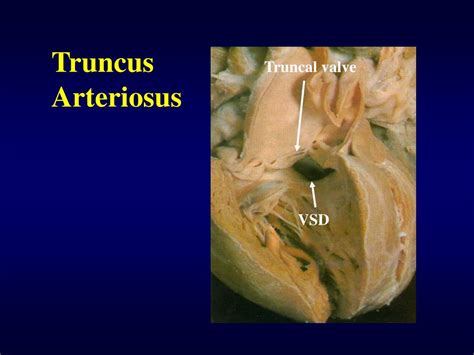 Ppt Truncus Arteriosus Powerpoint Presentation Free Download Id 597141