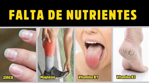 Sinais E Sintomas De Falta De Nutrientes Importantes Vitaminas E