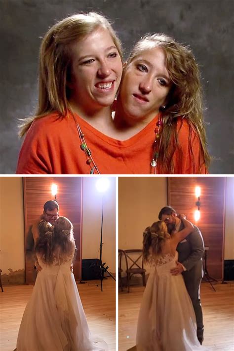 Taking A Look At The Miraculous Conjoined Twins Years Later Artofit