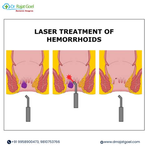 Piles Laser Treatment A Modern Approach To Relieving Discomfort Dr