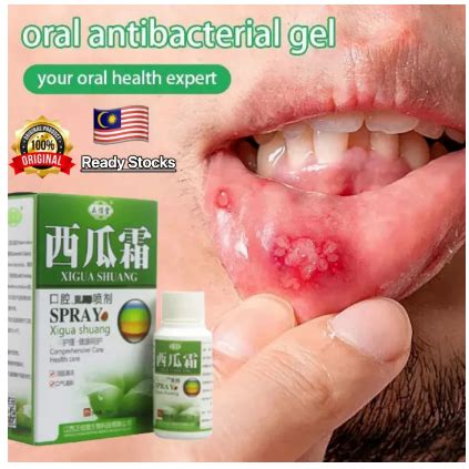 Oral Ulcer Spray Natural Herbal Mouth Ulcer Care Spray 30ml Ubat