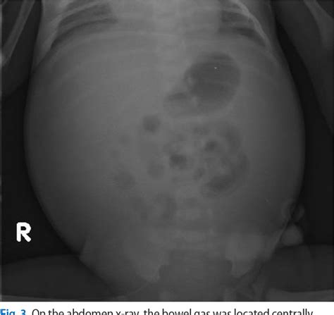 Figure From Ileal Atresia Presenting With Massive Chylous Ascites And