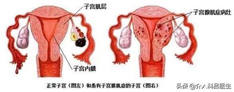 痛經、不孕、貧血，嚴重的子宮腺肌症腺肌瘤如何治癒？ 每日頭條