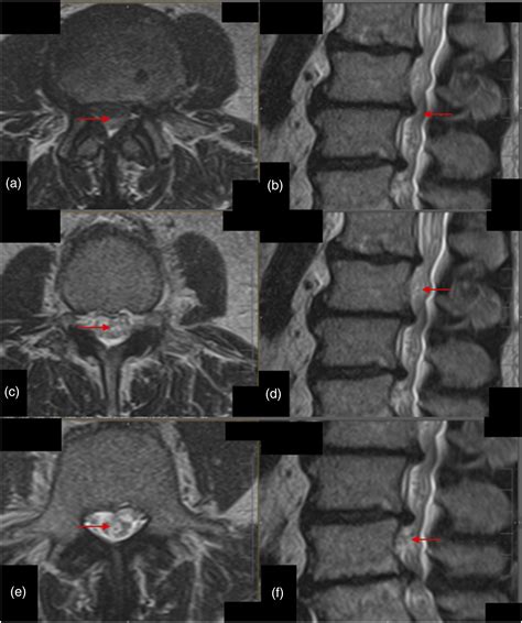 Gatorsign For Severe Lumbar Spinal Canal Stenosis Magnetic Resonance